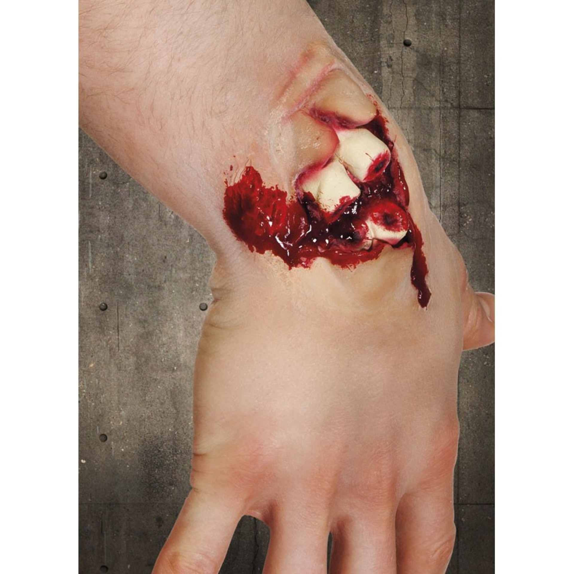 Aplicação FX Fractura Exposta